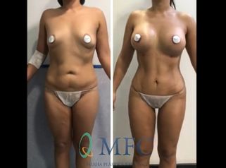 Lipoescultura