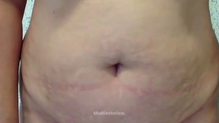 Consigue el abdomen que buscas