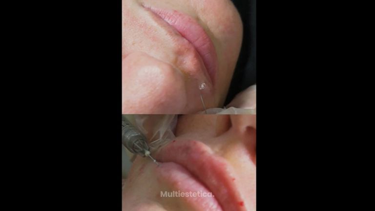 Aumento labios - IMSEI CLINIC