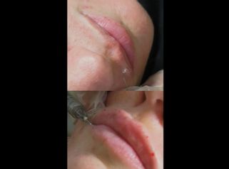 Aumento labios - IMSEI CLINIC