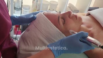 Microneedling - Clínica Senses