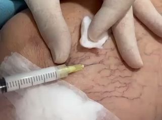 ¿Tratamiento de varices Aquí te contamos lo que no te suelen decir... 🦵✨