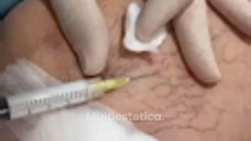 ¿Tratamiento de varices Aquí te contamos lo que no te suelen decir... 🦵✨