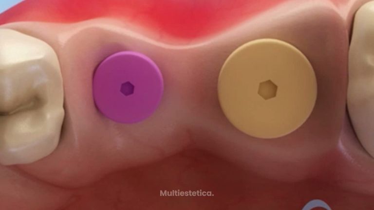 Así es la atrofia tras una extracción dental