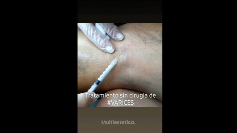 Tratamiento varices - Doctora Barba Martínez