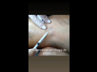 Tratamiento varices - Doctora Barba Martínez