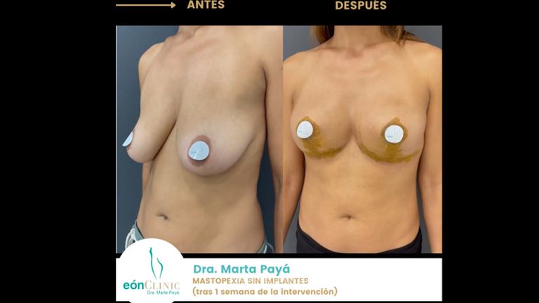Mastopexia - Dra. Marta Payá