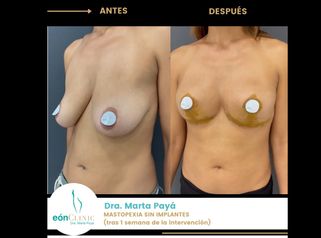 Mastopexia - Dra. Marta Payá