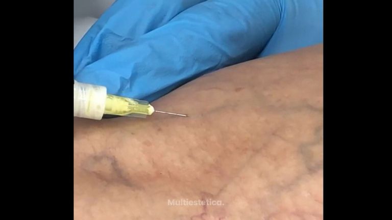 Tratamiento de varices - Clínica Dr. Carvajal