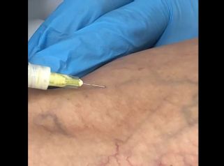 Tratamiento de varices - Clínica Dr. Carvajal