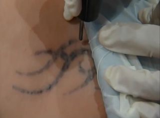 Eliminación de tatuajes con láser de Nd-Yag Q-Swchited 