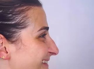 Nuestra guapísima paciente a los 7 meses después