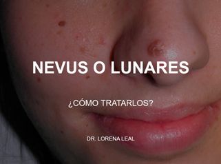 Nevus o lunares -  Clínica Tufet