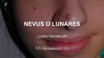 Nevus o lunares -  Clínica Tufet