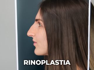 Rinoplastia - Clínica Opción Médica
