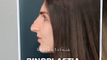 Rinoplastia - Clínica Opción Médica