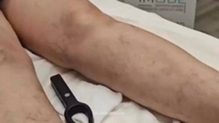 ¿Varices? - Grupo Médico Clínicas Massana