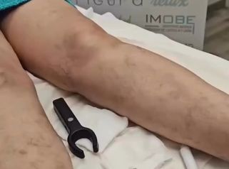 ¿Varices? - Grupo Médico Clínicas Massana