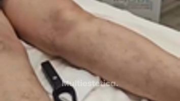 ¿Varices? - Grupo Médico Clínicas Massana
