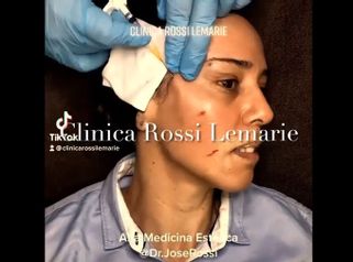 Bótox - Clínica Rossi Lemarie