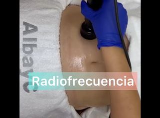 Radiofrecuencia - ClinicaAlbayC