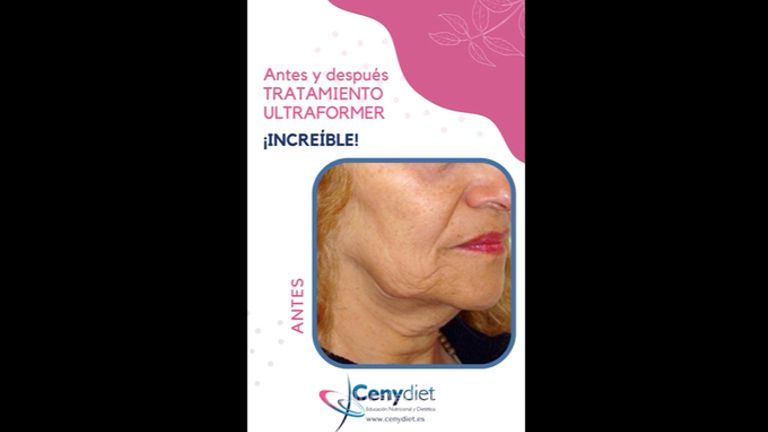 Tratamiento Ultraformer - Cenydiet