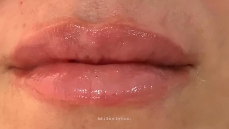 Aumento de labios - Dr. Juan Enrique Pérez Enríquez