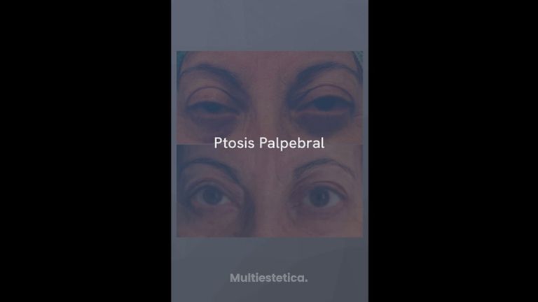 Ptosis Palpebral - Dr. Jiménez Ortiz