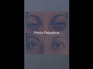 Ptosis Palpebral - Dr. Jiménez Ortiz