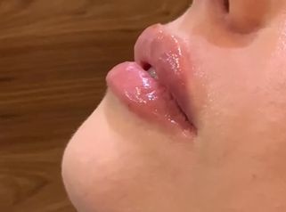 Aumento de labios - Dr. Juan Enrique Pérez Enríquez