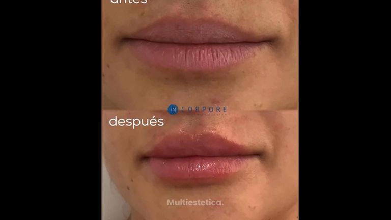 Aumento de labios - Dr. Juan Enrique Pérez Enríquez