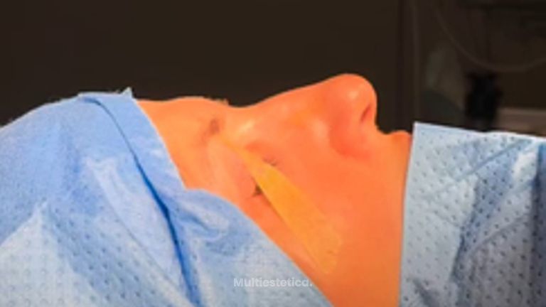 Rinoplastia - Clinica Silvia Roson