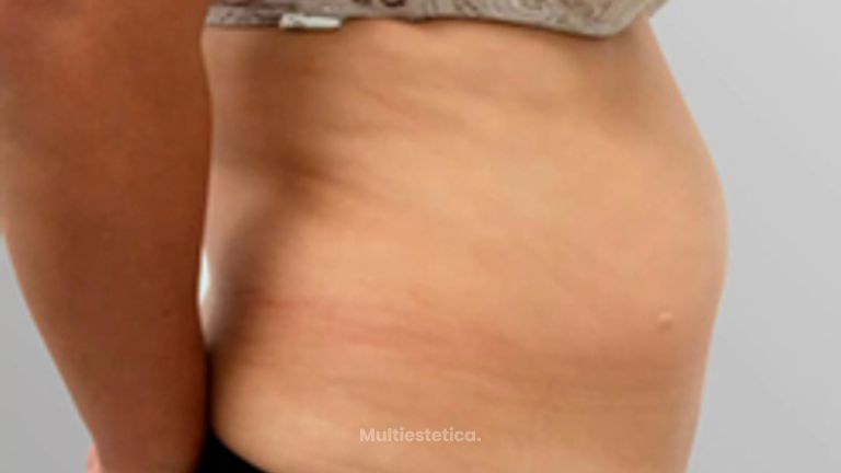 Abdominoplastia - Clinicas Came Cartagena