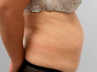 Abdominoplastia - Clinicas Came Cartagena