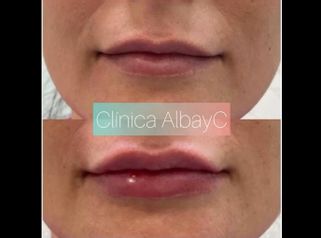 Aumento de labios - ClinicaAlbayC
