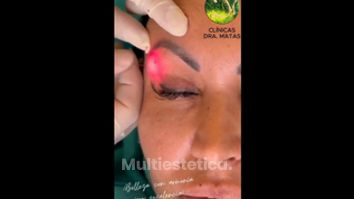 Blefaroplastia sin cirugía - Clínicas Dra. Matas