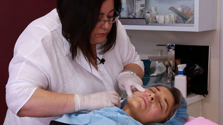 Guía práctica: todo lo que debes saber sobre rellenos faciales