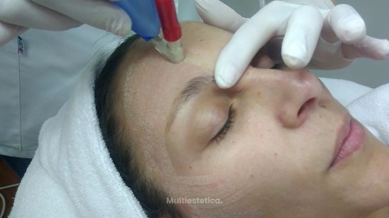Tratamiento estético: microdermoabrasión con cristales de corindón