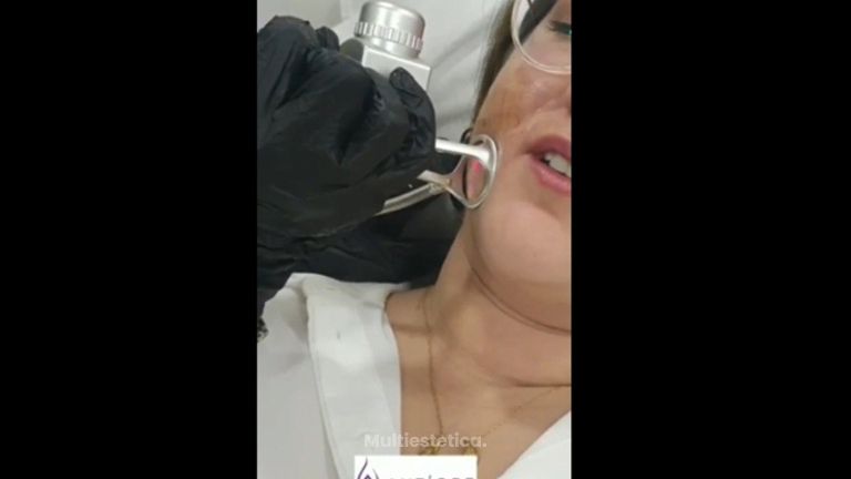 tratamiento con LASER CO2 de cicatrices de acné - Doctora Barba Martínez