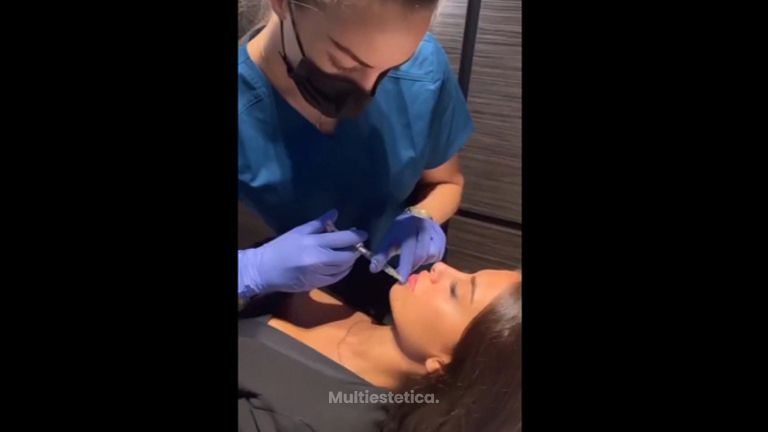 Aumento de labios - Dra. Elena Berezo