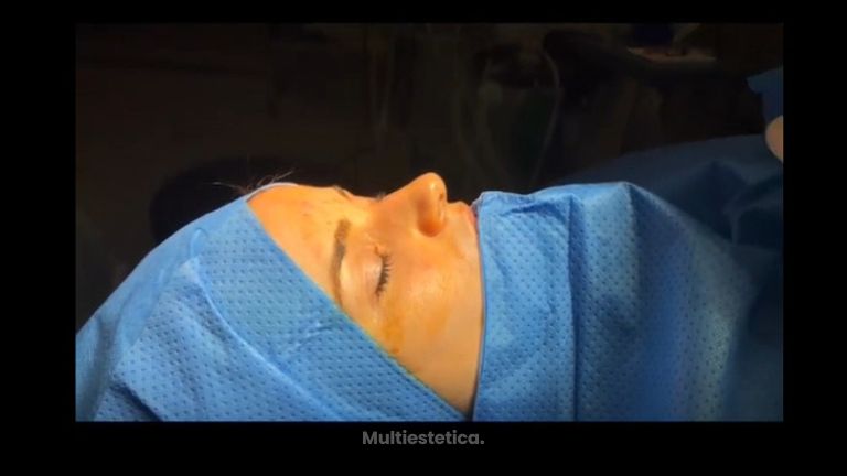 RINOPLASTIA - DRA. SILVIA ROSON