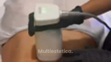 ELIMINAMOS LA GRASA LOCALIZADA