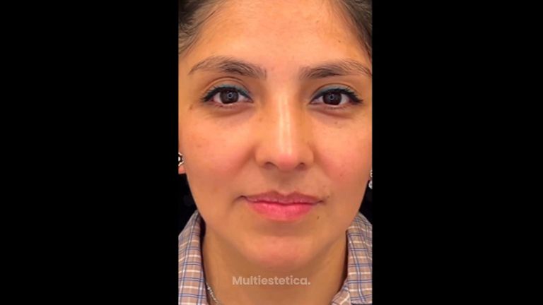 Rinoplastia - Dr. Jorge Noguera