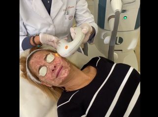 Tratamiento láser facial - Clínica Planas