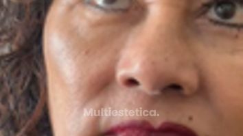 Blefaroplastia - Dr. Carlos Miera