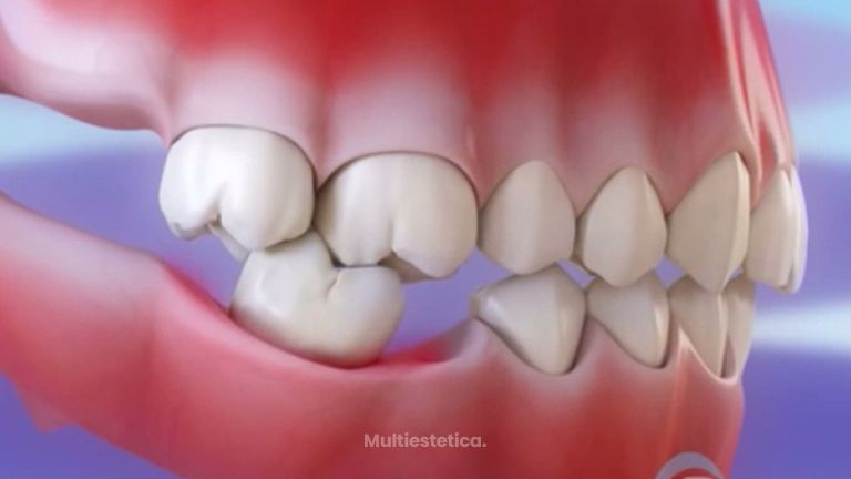 La importancia de reponer los dientes caídos