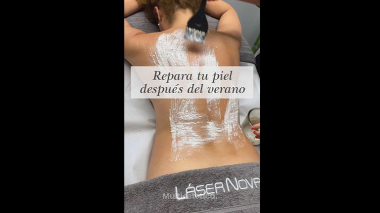 Exfoliacidón corporal   - Clínica Lasernova