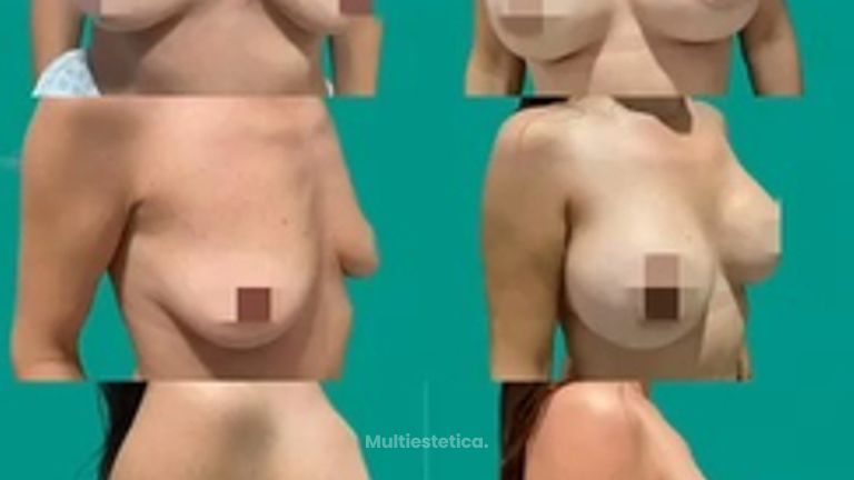 Cirugía combinada,  Abdominoplastia y mastopexia con prótesis