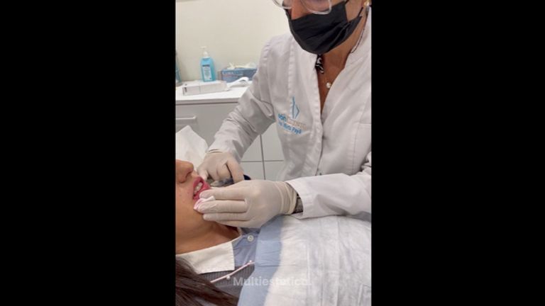 Aumento de labios - Dra. Marta Payá