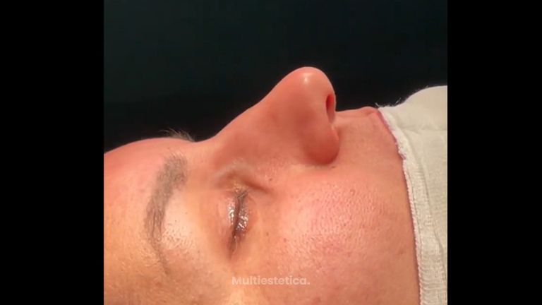 Rinoplastia - Dr. Pérez Villar